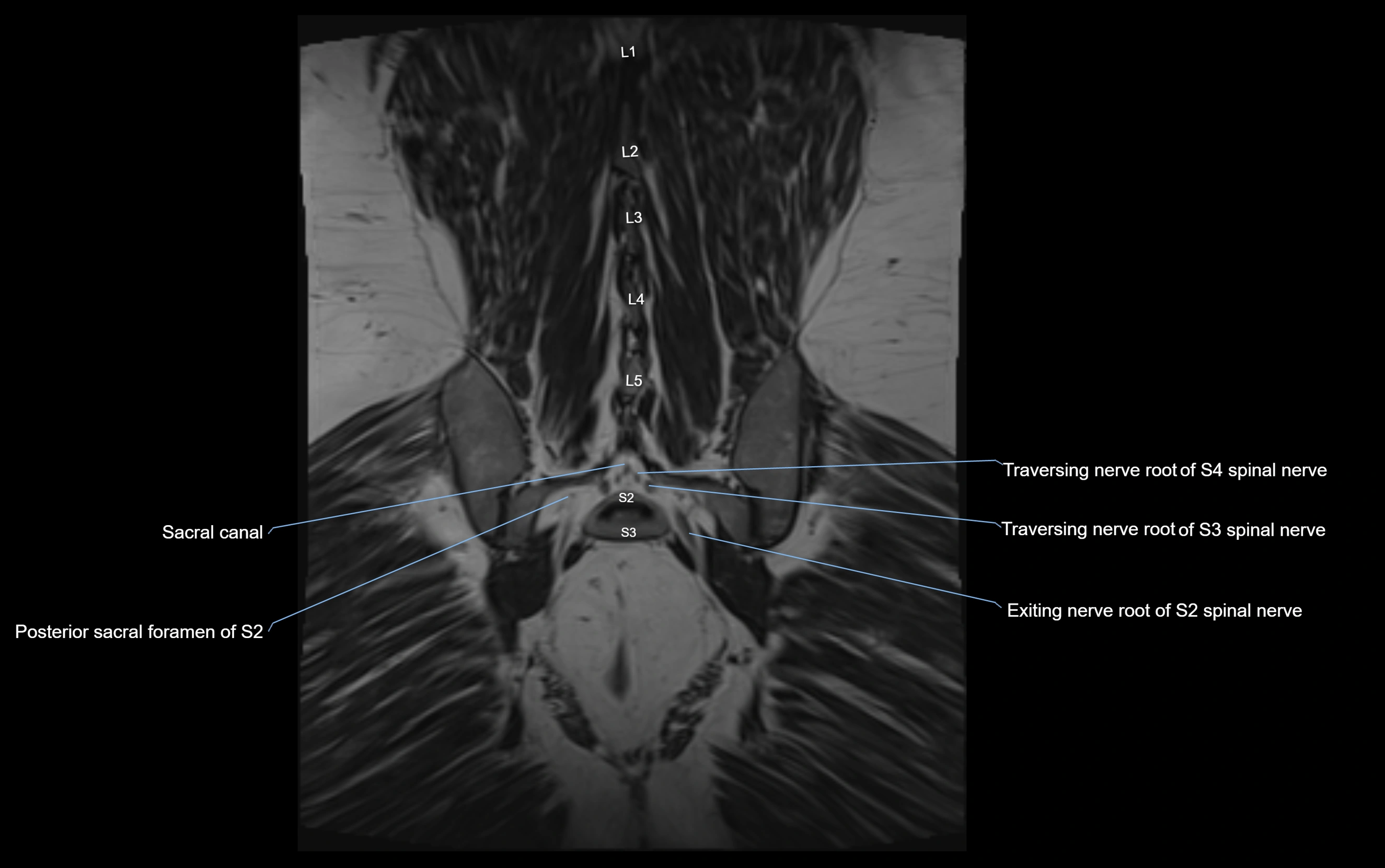 MR lumbosacral plexus cross sectional anatomy 3T  radiology  image-img-09001-00066.webp